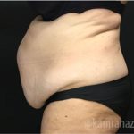 Tummy Tuck Before & After Patient #2838