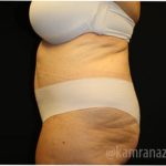 Tummy Tuck Before & After Patient #2838