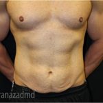 Tummy Tuck Before & After Patient #2839