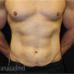 Tummy Tuck Before & After Patient #2839