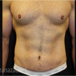 Tummy Tuck Before & After Patient #2839