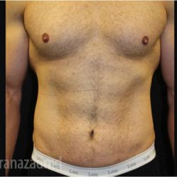 Tummy Tuck Before & After Patient #2839
