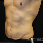 Tummy Tuck Before & After Patient #2839