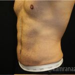 Tummy Tuck Before & After Patient #2839
