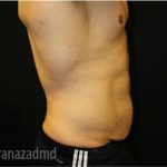 Tummy Tuck Before & After Patient #2839