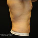 Tummy Tuck Before & After Patient #2839