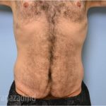 Tummy Tuck Before & After Patient #2840