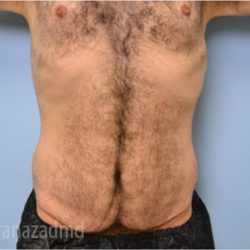 Tummy Tuck Before & After Patient #2840