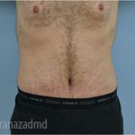 Tummy Tuck Before & After Patient #2840