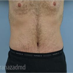 Tummy Tuck Before & After Patient #2840