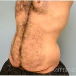 Tummy Tuck Before & After Patient #2840