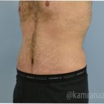Tummy Tuck Before & After Patient #2840