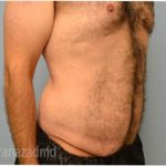 Tummy Tuck Before & After Patient #2840