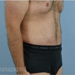 Tummy Tuck Before & After Patient #2840