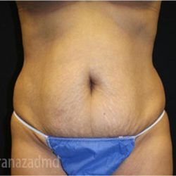 Tummy Tuck Before & After Patient #2841