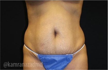 Tummy Tuck Before & After Patient #2841
