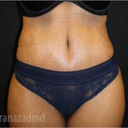 Tummy Tuck Before & After Patient #2841