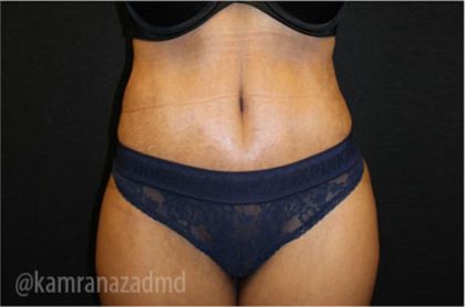 Tummy Tuck Before & After Patient #2841