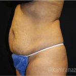 Tummy Tuck Before & After Patient #2841