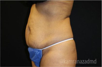 Tummy Tuck Before & After Patient #2841