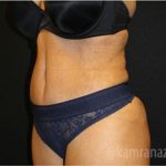 Tummy Tuck Before & After Patient #2841