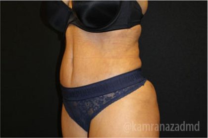 Tummy Tuck Before & After Patient #2841