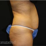 Tummy Tuck Before & After Patient #2841