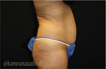 Tummy Tuck Before & After Patient #2841