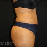 Tummy Tuck Before & After Patient #2841