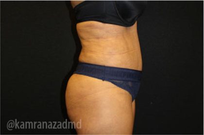 Tummy Tuck Before & After Patient #2841
