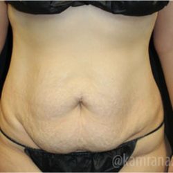 Tummy Tuck Before & After Patient #2842