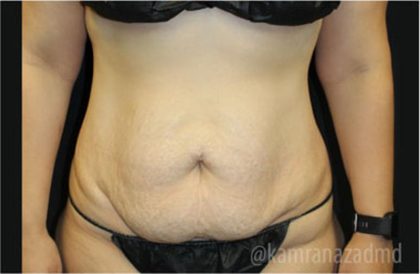 Tummy Tuck Before & After Patient #2842