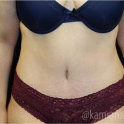 Tummy Tuck Before & After Patient #2842