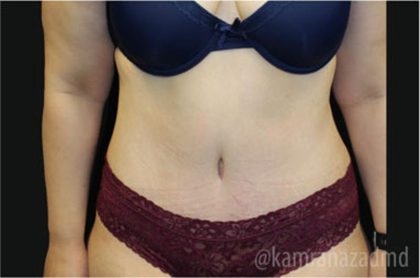 Tummy Tuck Before & After Patient #2842