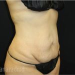 Tummy Tuck Before & After Patient #2842