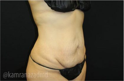 Tummy Tuck Before & After Patient #2842