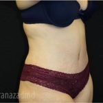 Tummy Tuck Before & After Patient #2842