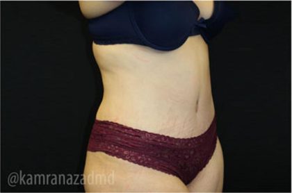 Tummy Tuck Before & After Patient #2842