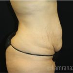 Tummy Tuck Before & After Patient #2842