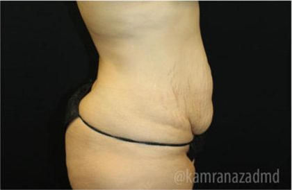 Tummy Tuck Before & After Patient #2842