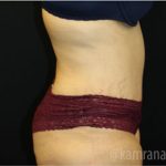 Tummy Tuck Before & After Patient #2842