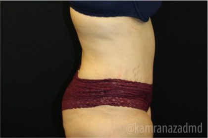 Tummy Tuck Before & After Patient #2842