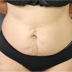 Tummy Tuck Before & After Patient #2824