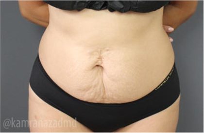 Tummy Tuck Before & After Patient #2824