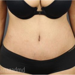 Tummy Tuck Before & After Patient #2824