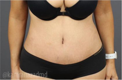 Tummy Tuck Before & After Patient #2824