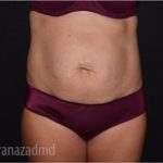 Tummy Tuck Before & After Patient #2843
