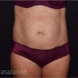 Tummy Tuck Before & After Patient #2843