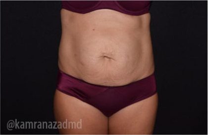 Tummy Tuck Before & After Patient #2843