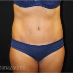 Tummy Tuck Before & After Patient #2843